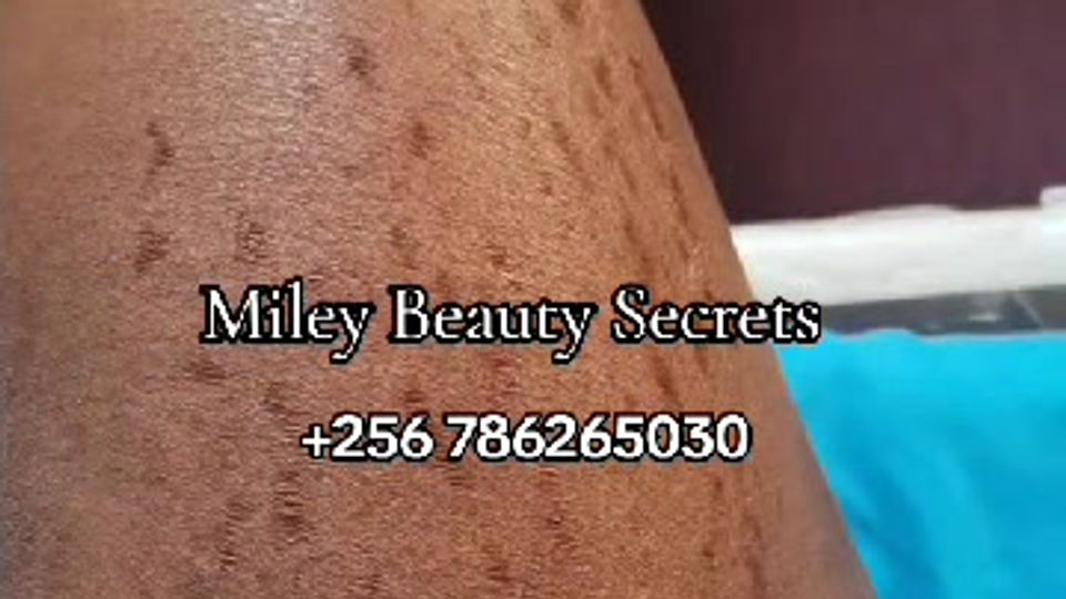 Stretchmarks Peeling Treatment